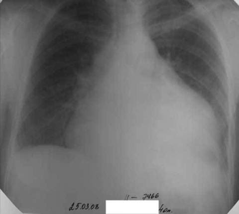 Рентгенография органов грудной клетки при экссудативном перикардите Рентгенография органов грудной клетки при экссудативном перикардите