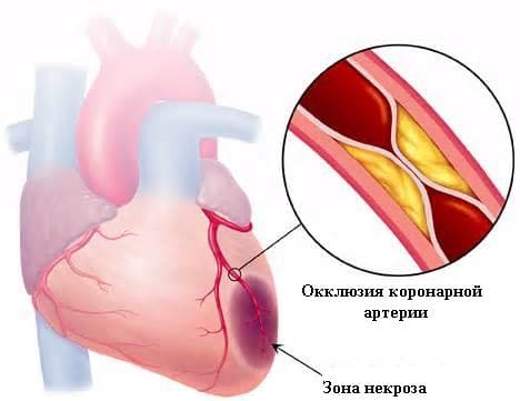 Повторный инфаркт миокарда