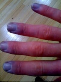 Синюшность конечных фаланг пальцев кисти при синдроме Рейно