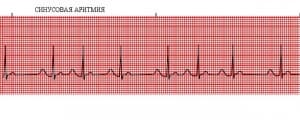 Нарушение синусового ритма сердца Нарушение синусового ритма сердца