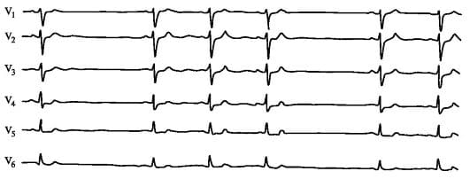 Нарушение синусового ритма сердца Нарушение синусового ритма сердца