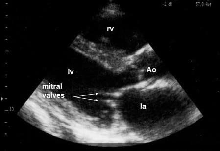 утолщенные створки митрального клапана при стенозе утолщенные створки митрального клапана при стенозе
