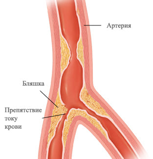 Стабильная стенокардия (напряжения)