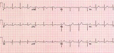 Нормальная ЭКГ
