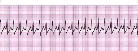 Наджелудочковая тахикардия