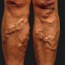 Варикозные вены на ногах. Симптомы варикозной болезни