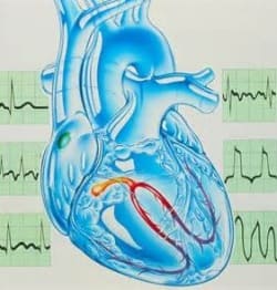 Желудочковая экстрасистолия