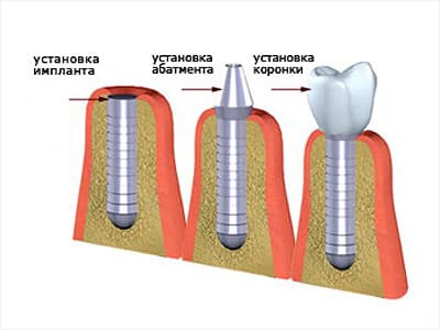 Этапы установки имплантата