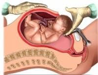 Беременность и роды с рубцом на матке после кесарева, удаления миомы