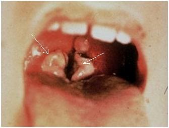 Дифтерия зева: плотные, плохо снимающиеся налеты на миндалинах Дифтерия зева: плотные, плохо снимающиеся налеты на миндалинах