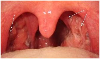 Признаки хронического тонзиллита: рубцовые изменения миндалин, спайки с небными дужками Признаки хронического тонзиллита: рубцовые изменения миндалин, спайки с небными дужками