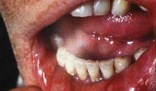 Заболевания десен: гингивит Заболевания десен: гингивит