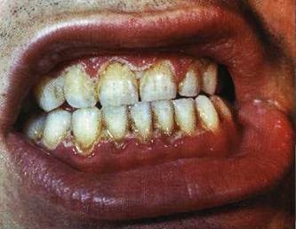 Заболевания десен: гингивит Заболевания десен: гингивит