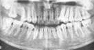 Заболевания десен: гингивит, пародонтит, пародонтоз Заболевания десен: гингивит, пародонтит, пародонтоз