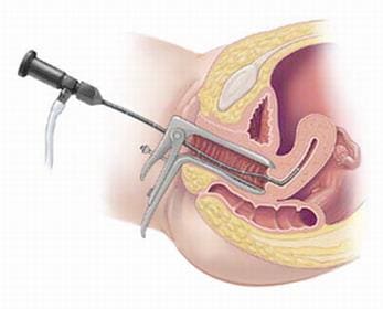 Гистероскопия – осмотр полости матки. Лечение ДМК