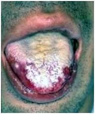 Кандидозный стоматит