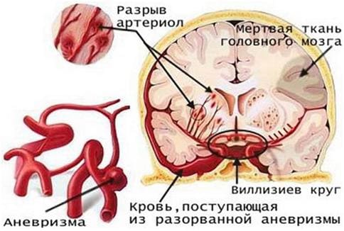 Геморрагический инсульт Геморрагический инсульт