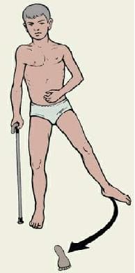 Поза Вернике – Мана у больного перенесшего геморрагический инсульт Поза Вернике – Мана у больного перенесшего геморрагический инсульт