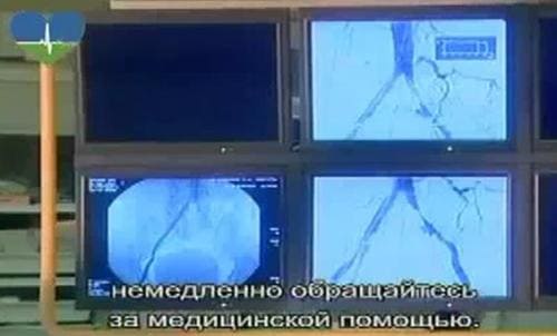 Ангиография сосудов головного мозга после инсульта Ангиография сосудов головного мозга после инсульта