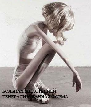 Генерализованная форма миастении симптомы Генерализованная форма миастении симптомы