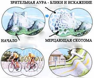 Симптомы мигрени Симптомы мигрени