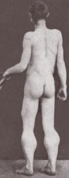 Псевдогипертрофии икроножных мышц у больного миопатией Псевдогипертрофии икроножных мышц у больного миопатией