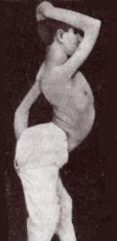 Осиная талия и гиперлордоз у больного миопатией Осиная талия и гиперлордоз у больного миопатией