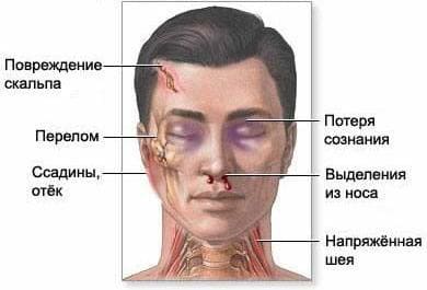 Признаки черепно-мозговой травмы Признаки черепно-мозговой травмы