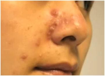 Пиодермия при стафилококковой инфекции симптомы Пиодермия при стафилококковой инфекции симптомы