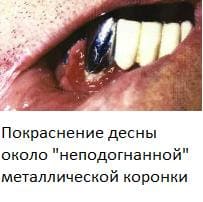 Стоматит воспаление полости рта симптомы с фото Стоматит воспаление полости рта симптомы с фото