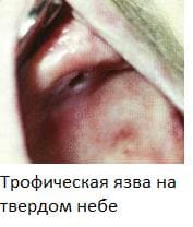 Стоматит воспаление полости рта симптомы с фото Стоматит воспаление полости рта симптомы с фото