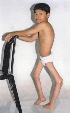 Фото ребенка, перенесшего полиомиелит Фото ребенка, перенесшего полиомиелит