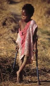 Фото ребенка, перенесшего полиомиелит