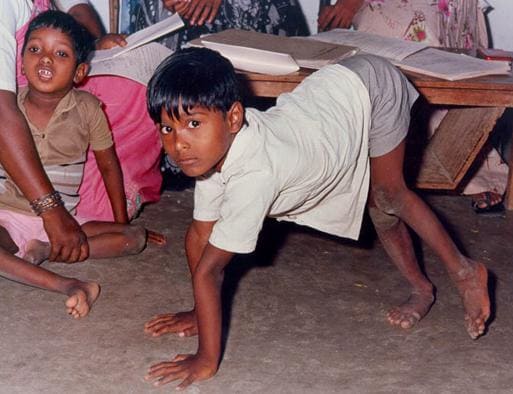 Фто больных полиомиелитом Фто больных полиомиелитом