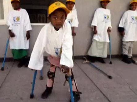 Гипотонус, обусловленный полиомиелитом Гипотонус, обусловленный полиомиелитом