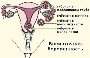 Внематочная беременность - Причины, симптомы и лечение