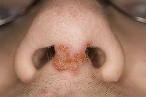 Фото импетиго - симптомы стрептодермии Фото импетиго - симптомы стрептодермии