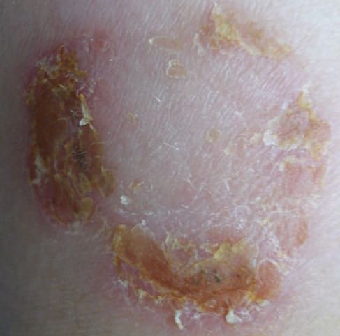 Фото импетиго - симптомы стрептодермии Фото импетиго - симптомы стрептодермии