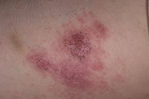 Фото эктима - симптомы стрептодермии Фото эктима - симптомы стрептодермии