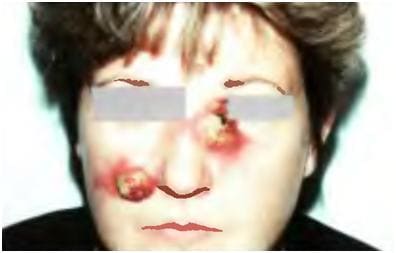 Рак придатков кожи Рак придатков кожи