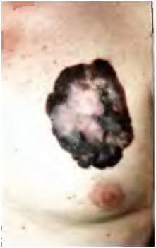 Меланома Меланома