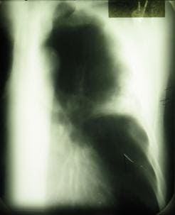 Сегментарный ателектаз верхней доли левого легкого, вызванный опухолью сегментарных бронхов Сегментарный ателектаз верхней доли левого легкого, вызванный опухолью сегментарных бронхов