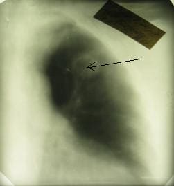 Полостная форма рака легкого Опухоль в правом легком указана стрелкой