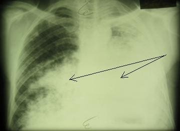 пневмониеподобная форма рака легкого с поражением обоих легких пневмониеподобная форма рака легкого с поражением обоих легких