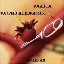 Клипирование аневризмы Клипирование аневризмы