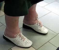 Слоновость Слоновость