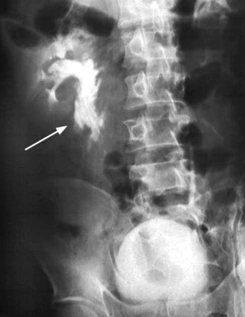 Анурия на экскреторной урограмме