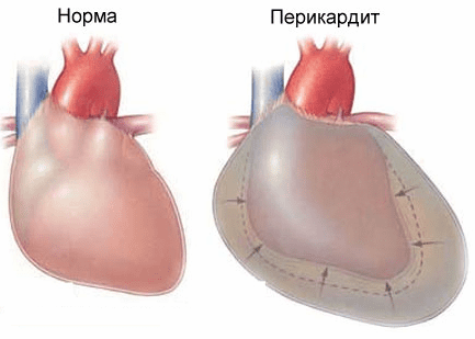 Боль в области сердца