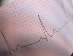 Сбой сердечного ритма что делать