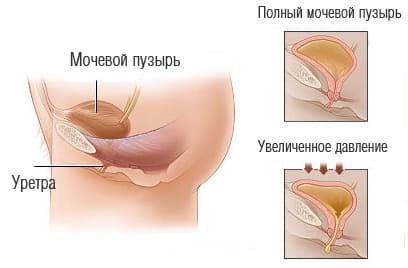 Неврогенное недержание мочи